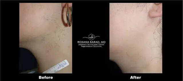 Laser Skin Resurfacing result at Aesthetic Skin & Laser Center in Pittsburgh, PA