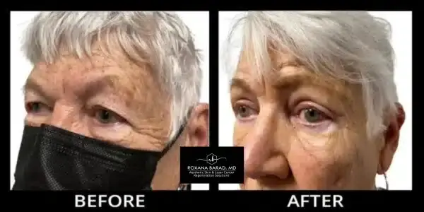 Aesthetic Skin & Laser Center eyelid lift result — Pittsburgh, PA