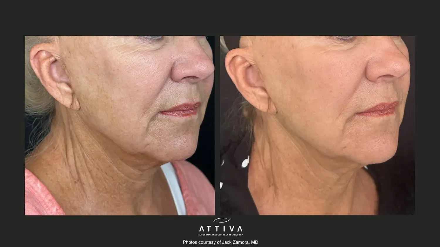 Aesthetic Skin & Laser Center result — Pittsburgh, PA