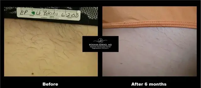 Laser Skin Resurfacing result at Aesthetic Skin & Laser Center in Pittsburgh, PA