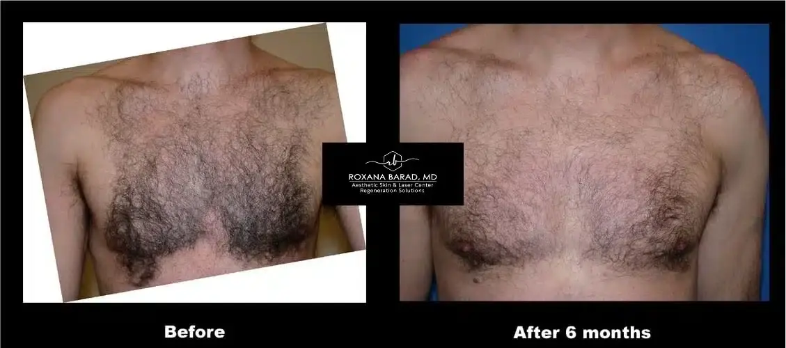 Aesthetic Skin & Laser Center laser treatment result — Pittsburgh, PA