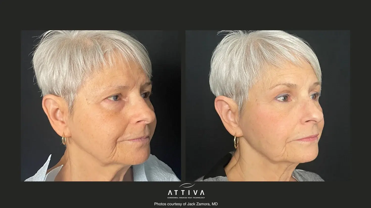 Aesthetic Skin & Laser Center result — Pittsburgh, PA