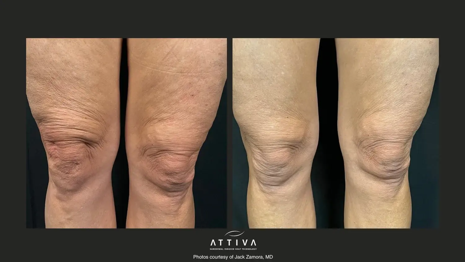 Aesthetic Skin & Laser Center result — Pittsburgh, PA