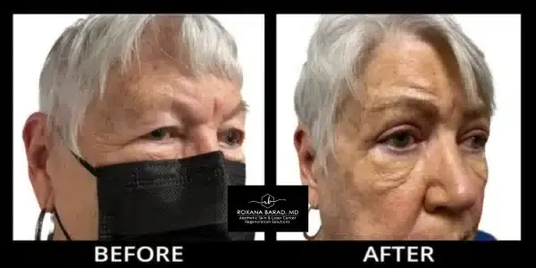 Aesthetic Skin & Laser Center eyelid lift result — Pittsburgh, PA