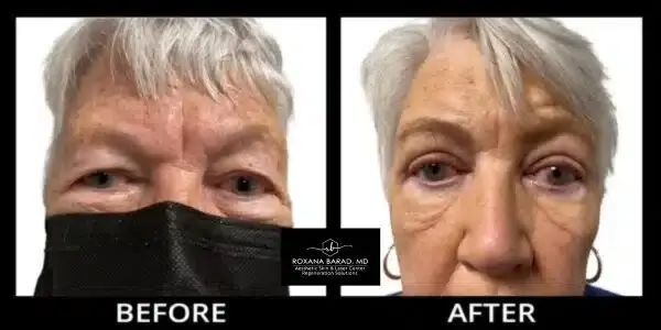 Aesthetic Skin & Laser Center eyelid lift result — Pittsburgh, PA