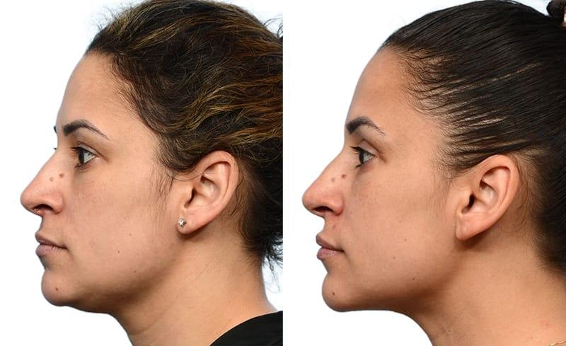 Jeffrey B. Wise, MD, FACS neck liposuction result — Wayne, NJ