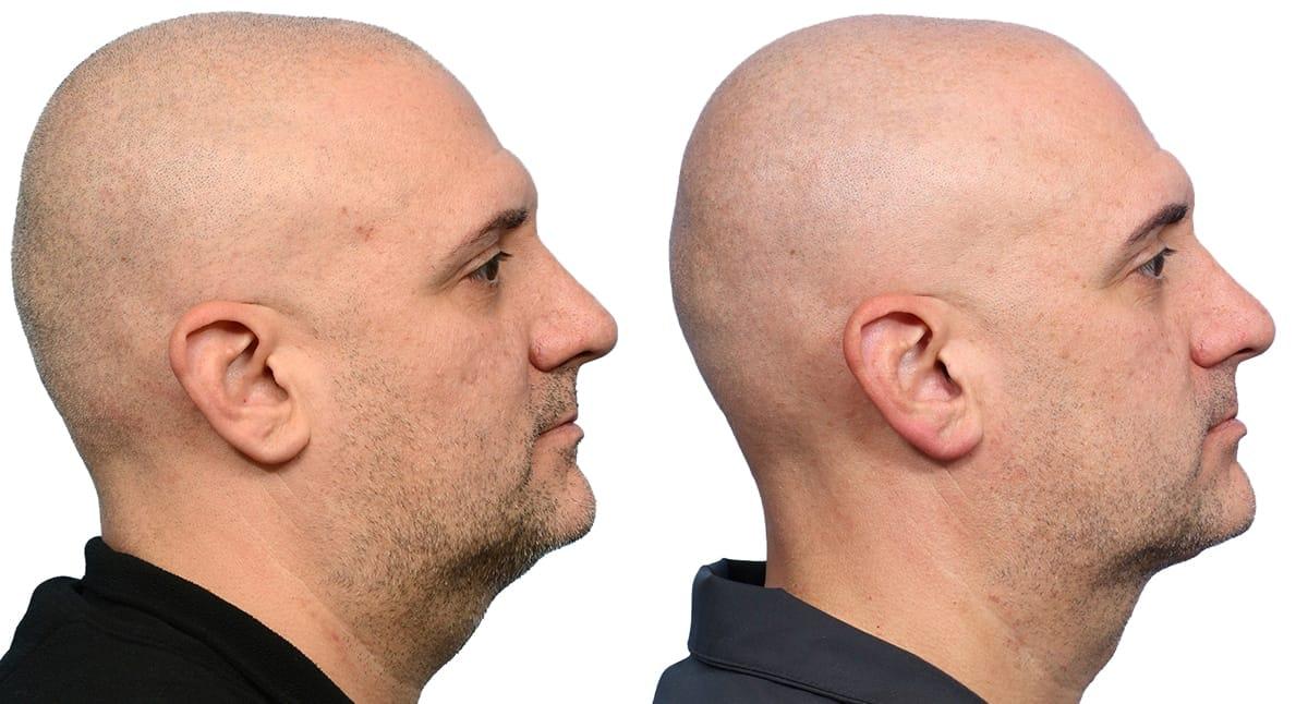 Jeffrey B. Wise, MD, FACS neck lift result — Wayne, NJ