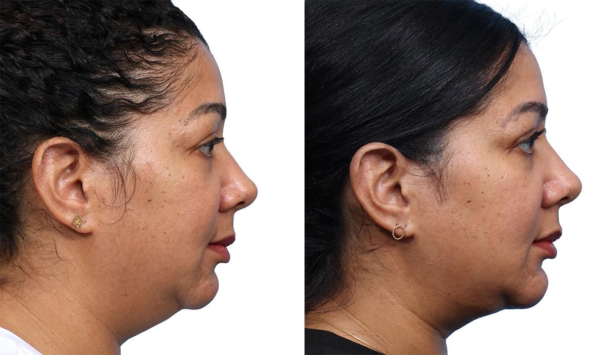 Jeffrey B. Wise, MD, FACS neck liposuction result — Wayne, NJ