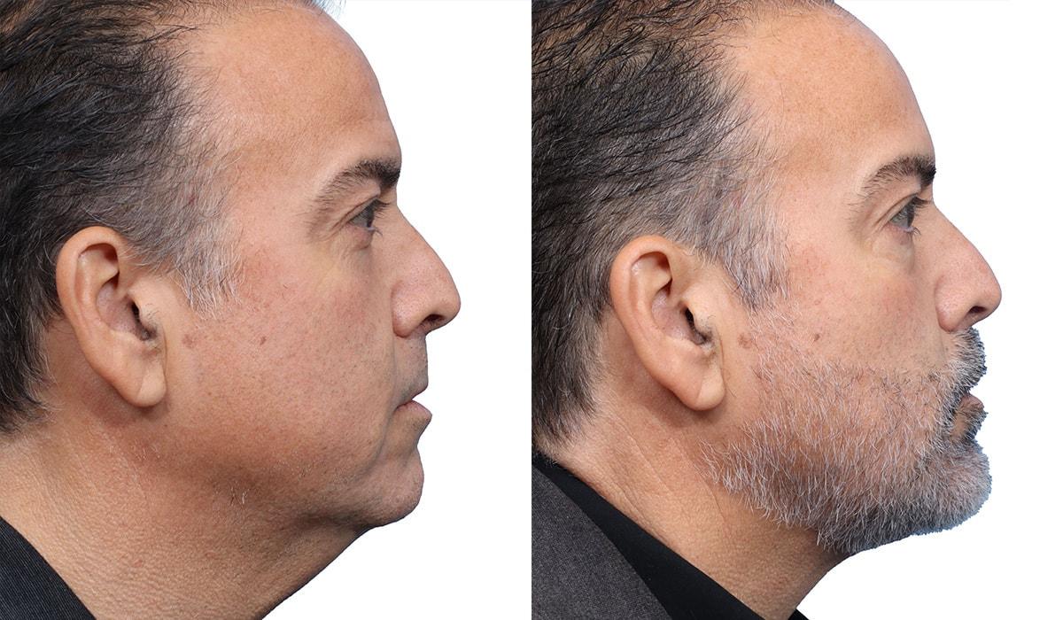 Jeffrey B. Wise, MD, FACS neck lift result — Wayne, NJ