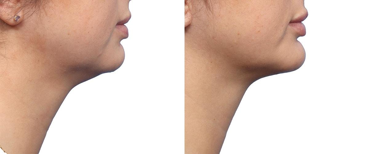 Jeffrey B. Wise, MD, FACS neck liposuction result — Wayne, NJ