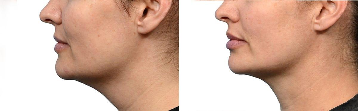 Jeffrey B. Wise, MD, FACS neck liposuction result — Wayne, NJ