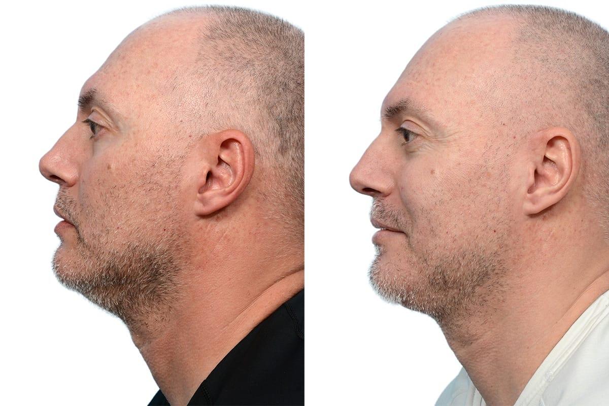 Jeffrey B. Wise, MD, FACS neck liposuction result — Wayne, NJ