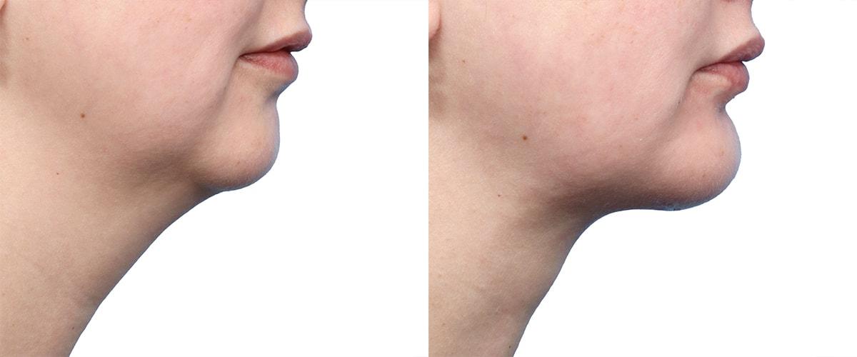 Jeffrey B. Wise, MD, FACS neck lift result — Wayne, NJ