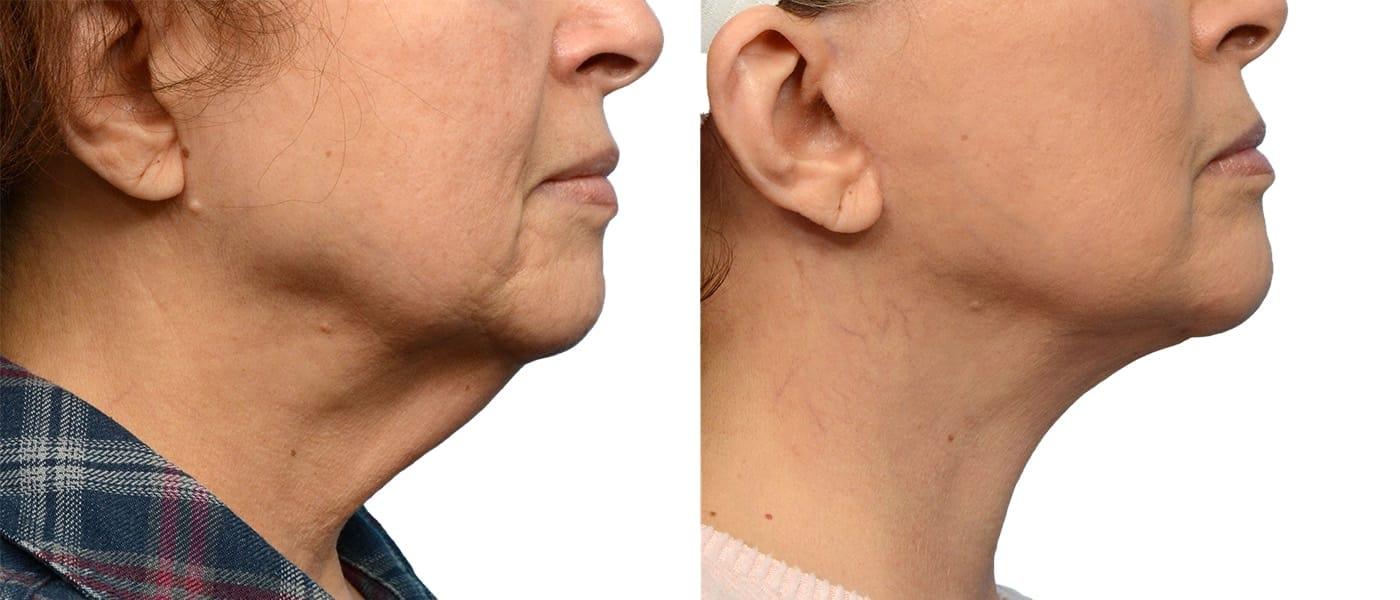 Jeffrey B. Wise, MD, FACS neck lift result — Wayne, NJ