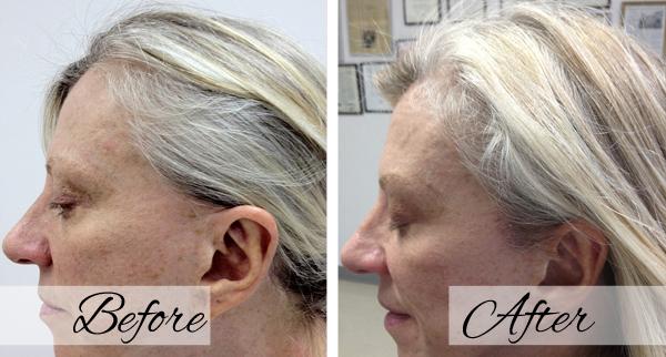 Dr.Riyaz Hassanali: Advanced Cosmetic Surgery Center hair restoration result — Buffalo, NY