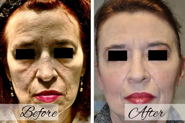 Dr.Riyaz Hassanali: Advanced Cosmetic Surgery Center laser treatment result — Buffalo, NY