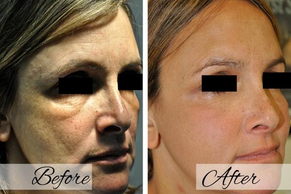 Dr.Riyaz Hassanali: Advanced Cosmetic Surgery Center laser treatment result — Buffalo, NY