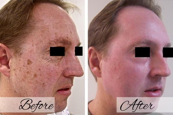 Laser Skin Resurfacing result at Dr.Riyaz Hassanali: Advanced Cosmetic Surgery Center in Buffalo, NY