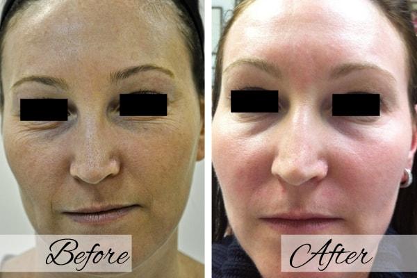 Laser Skin Resurfacing result at Dr.Riyaz Hassanali: Advanced Cosmetic Surgery Center in Buffalo, NY