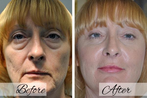 Dr.Riyaz Hassanali: Advanced Cosmetic Surgery Center eyelid lift result — Buffalo, NY