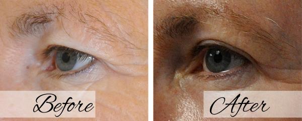 Dr.Riyaz Hassanali: Advanced Cosmetic Surgery Center blepharoplasty result — Buffalo, NY
