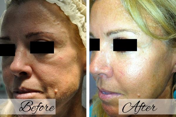 Dr.Riyaz Hassanali: Advanced Cosmetic Surgery Center laser treatment result — Buffalo, NY