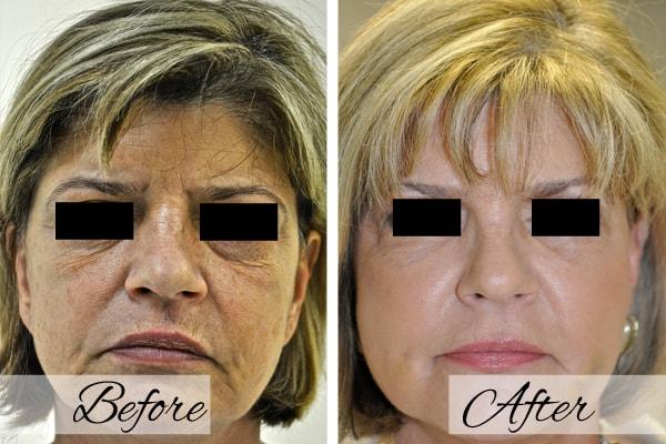 Dr.Riyaz Hassanali: Advanced Cosmetic Surgery Center laser treatment result — Buffalo, NY