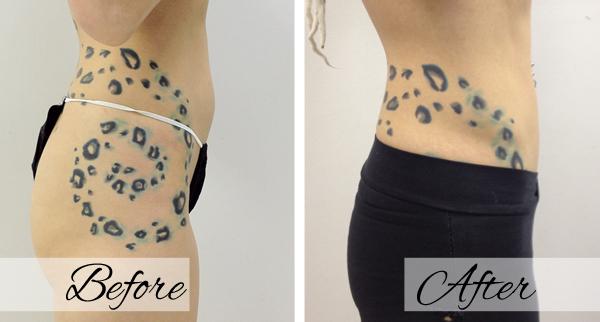 Liposuction result at Dr.Riyaz Hassanali: Advanced Cosmetic Surgery Center in Buffalo, NY