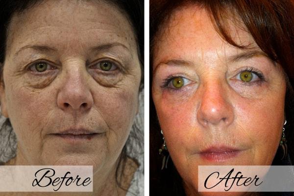 Dr.Riyaz Hassanali: Advanced Cosmetic Surgery Center eyelid lift result — Buffalo, NY