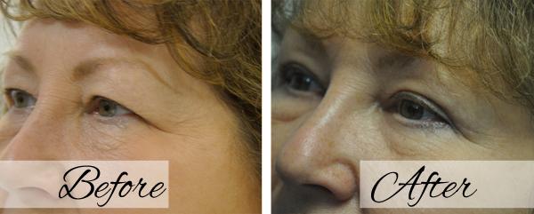 Blepharoplasty result at Dr.Riyaz Hassanali: Advanced Cosmetic Surgery Center in Buffalo, NY