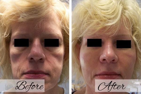 Dr.Riyaz Hassanali: Advanced Cosmetic Surgery Center laser treatment result — Buffalo, NY