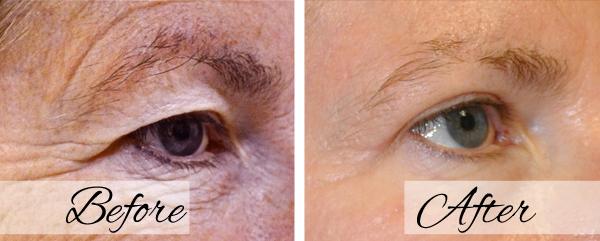 Dr.Riyaz Hassanali: Advanced Cosmetic Surgery Center blepharoplasty result — Buffalo, NY