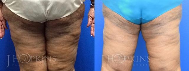 Thigh Lift result at J Hopkins Plastic Surgery in Dallas, TX