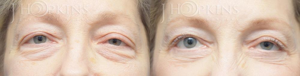 J Hopkins Plastic Surgery blepharoplasty result — Dallas, TX