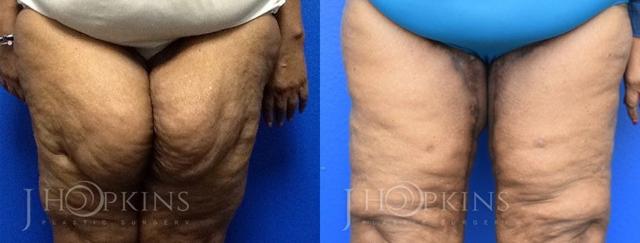 Thigh Lift result at J Hopkins Plastic Surgery in Dallas, TX