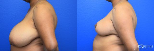 Breast Reduction result at J Hopkins Plastic Surgery in Dallas, TX