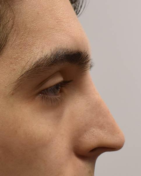 Liquid Rhinoplasty after at Gregory D. Lewen, MD Oculofacial Plastic Surgery in Aventura, FL