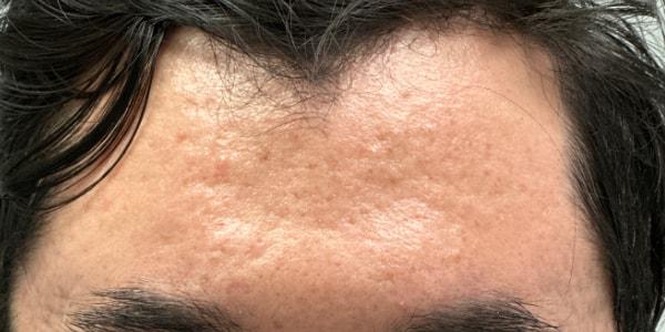 Chemical Peel before at Gregory D. Lewen, MD Oculofacial Plastic Surgery in Aventura, FL