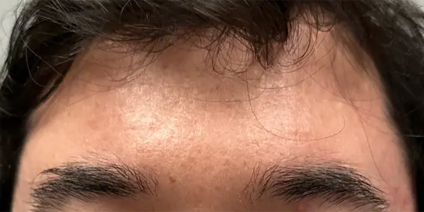 Chemical Peel after at Gregory D. Lewen, MD Oculofacial Plastic Surgery in Aventura, FL