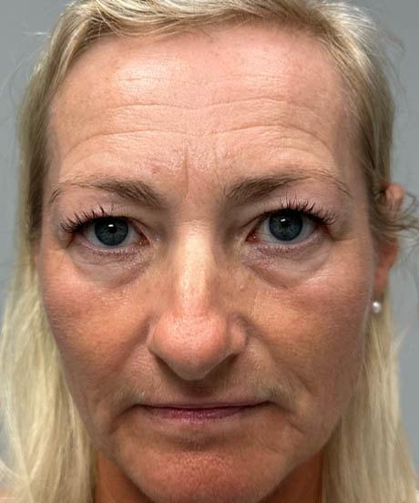 Brow Lift before at Gregory D. Lewen, MD Oculofacial Plastic Surgery in Aventura, FL