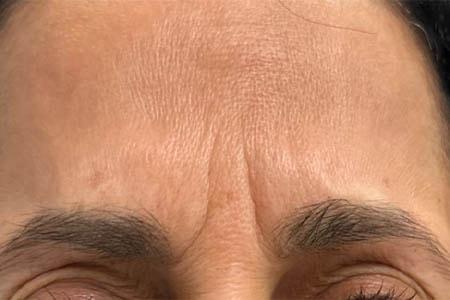Botox before at Gregory D. Lewen, MD Oculofacial Plastic Surgery in Aventura, FL
