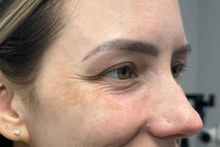 Botox before at Gregory D. Lewen, MD Oculofacial Plastic Surgery in Aventura, FL