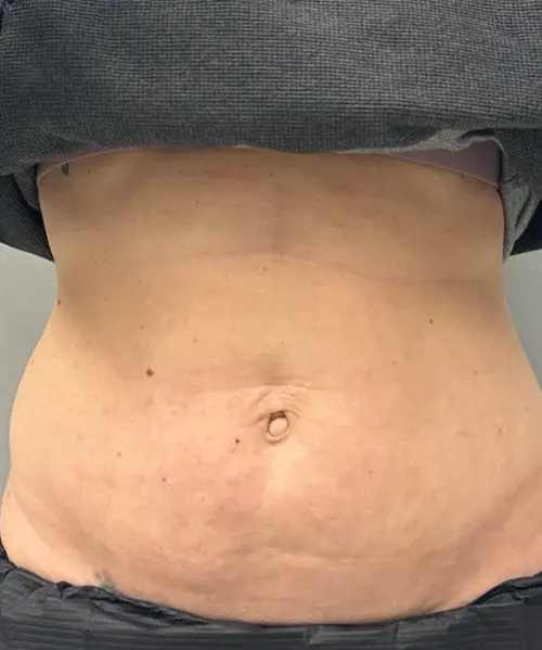 Morpheus8 after at Gregory D. Lewen, MD Oculofacial Plastic Surgery in Aventura, FL