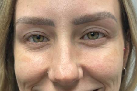 Botox after at Gregory D. Lewen, MD Oculofacial Plastic Surgery in Aventura, FL