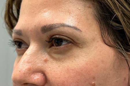 Gregory D. Lewen, MD Oculofacial Plastic Surgery blepharoplasty after — Aventura, FL