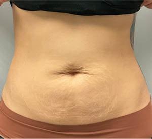 Morpheus8 before at Gregory D. Lewen, MD Oculofacial Plastic Surgery in Aventura, FL