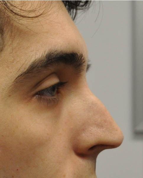 Liquid Rhinoplasty before at Gregory D. Lewen, MD Oculofacial Plastic Surgery in Aventura, FL