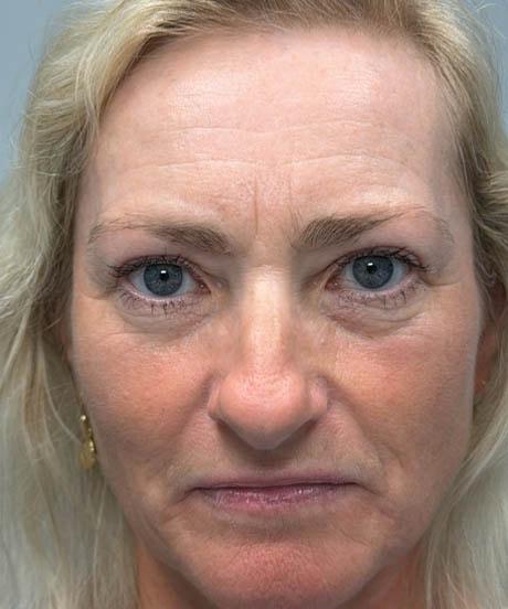 Brow Lift after at Gregory D. Lewen, MD Oculofacial Plastic Surgery in Aventura, FL