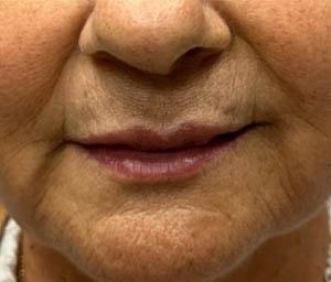 Lip Filler after at Gregory D. Lewen, MD Oculofacial Plastic Surgery in Aventura, FL