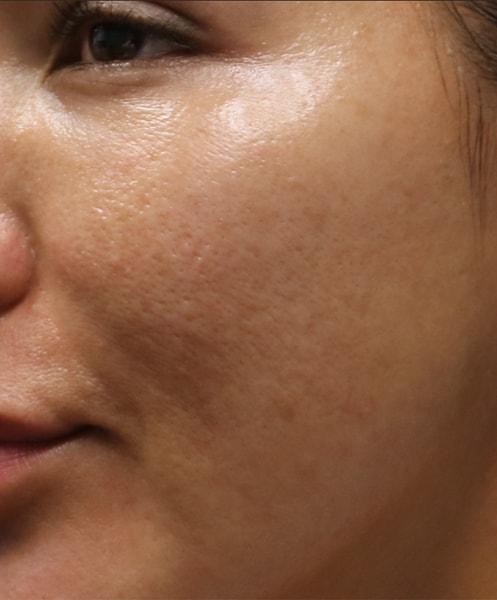 Morpheus8 after at Gregory D. Lewen, MD Oculofacial Plastic Surgery in Aventura, FL